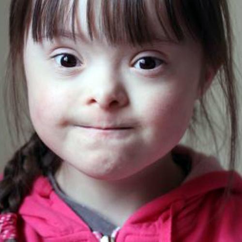 متلازمة داون